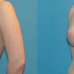 Breast Augmentation with Breast Implants #111 - Before and After