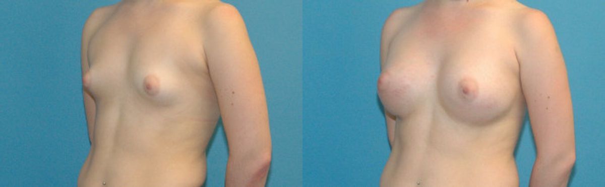 Breast Augmentation with Breast Implants #111 - Before and After
