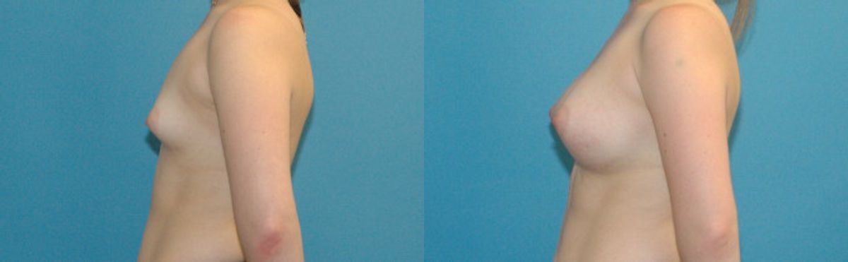 Breast Augmentation with Breast Implants #111 - Before and After