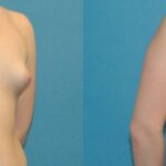Breast Augmentation with Breast Implants #111 - Before and After