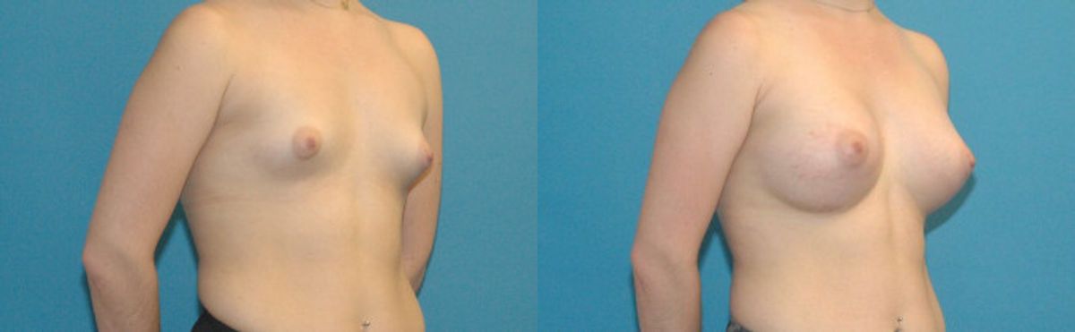 Breast Augmentation with Breast Implants #111 - Before and After