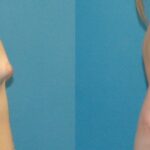 Breast Augmentation with Breast Implants #111 - Before and After
