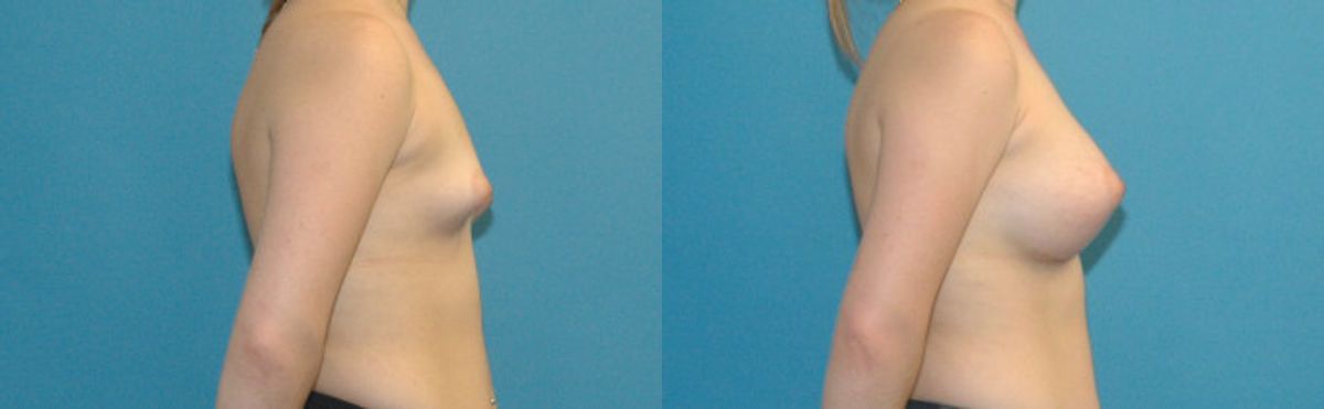 Breast Augmentation with Breast Implants #111 - Before and After