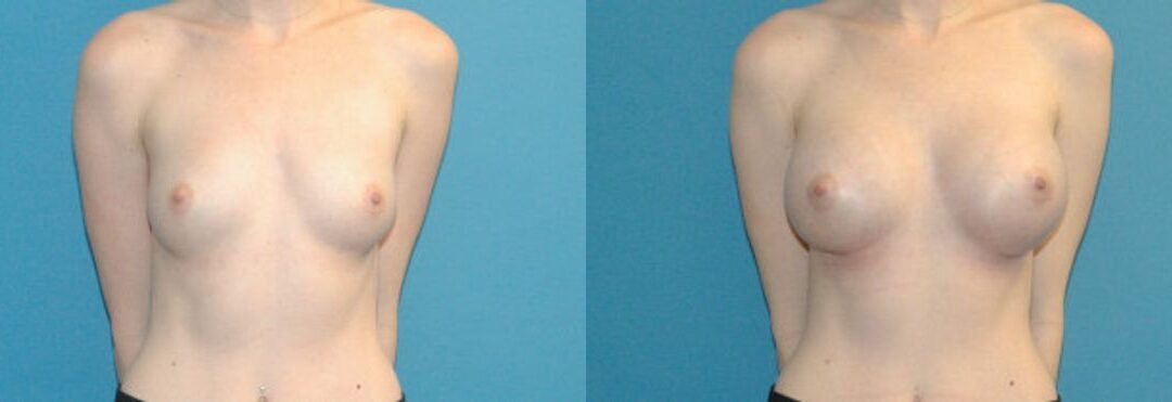 Breast Augmentation with Breast Implants #112