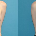 Breast Augmentation with Breast Implants #112 - Before and After