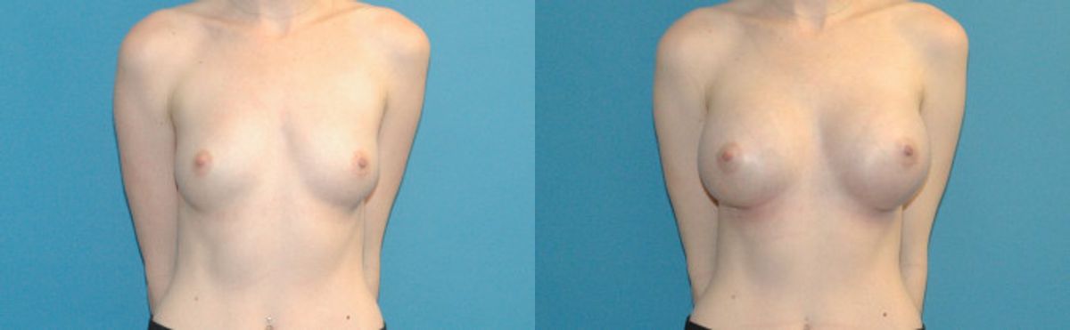 Breast Augmentation with Breast Implants #112 - Before and After