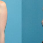 Breast Augmentation with Breast Implants #112 - Before and After