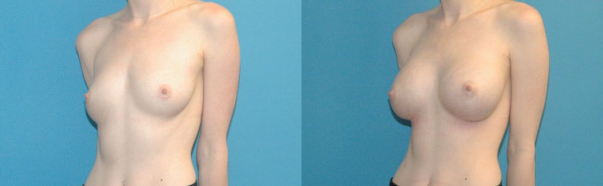 Breast Augmentation with Breast Implants #112 - Before and After