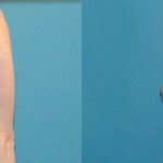 Breast Augmentation with Breast Implants #112 - Before and After