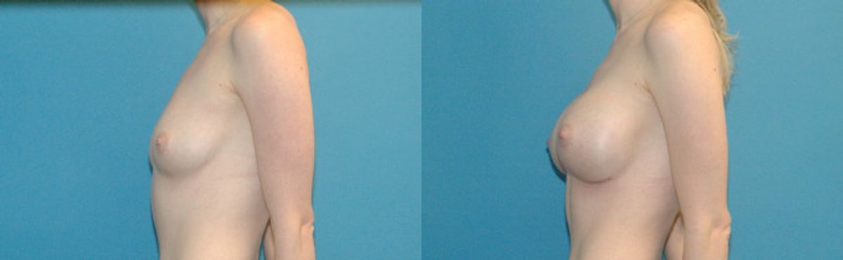 Breast Augmentation with Breast Implants #112 - Before and After