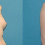 Breast Augmentation with Breast Implants #112 - Before and After
