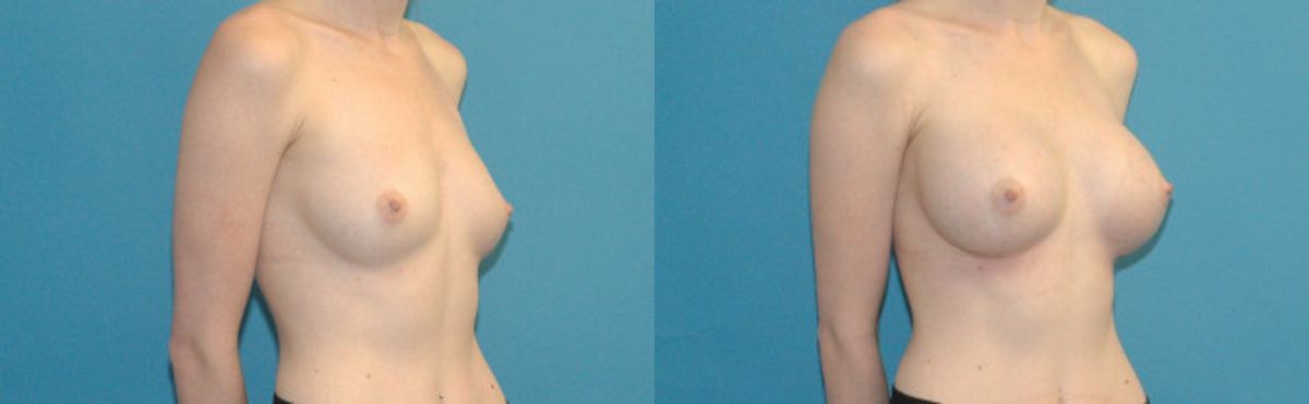 Breast Augmentation with Breast Implants #112 - Before and After