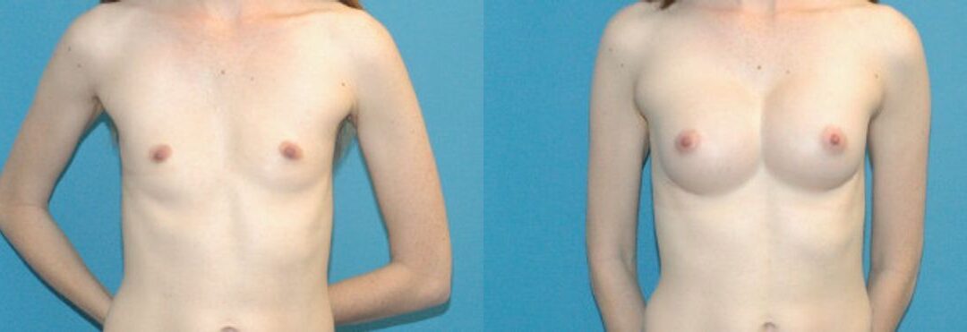 Breast Augmentation with Breast Implants #113