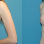 Breast Augmentation with Breast Implants #113 - Before and After