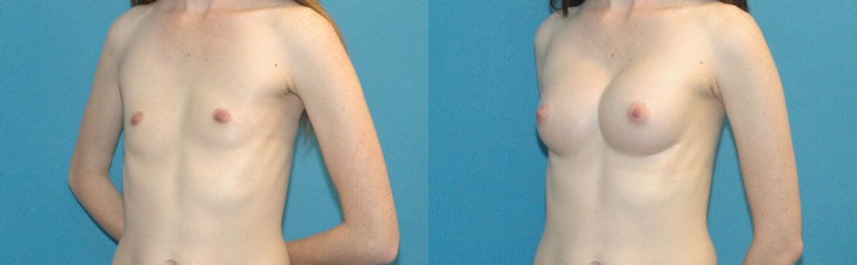 Breast Augmentation with Breast Implants #113 - Before and After