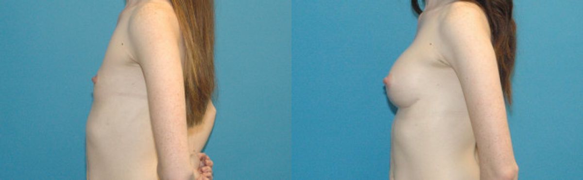 Breast Augmentation with Breast Implants #113 - Before and After