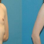 Breast Augmentation with Breast Implants #113 - Before and After