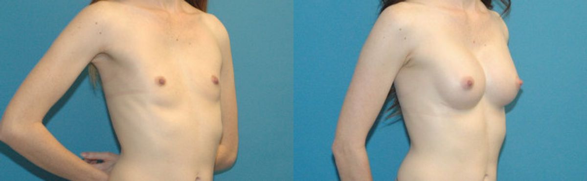 Breast Augmentation with Breast Implants #113 - Before and After