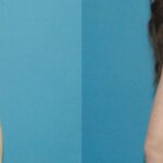 Breast Augmentation with Breast Implants #113 - Before and After