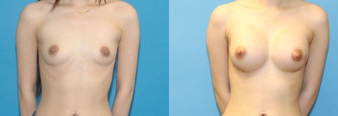 Breast Augmentation with Breast Implants #114