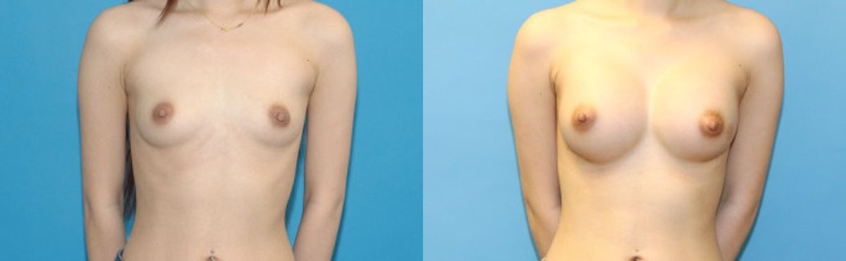Breast Augmentation with Breast Implants #114 - Before and After