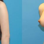 Breast Augmentation with Breast Implants #114 - Before and After