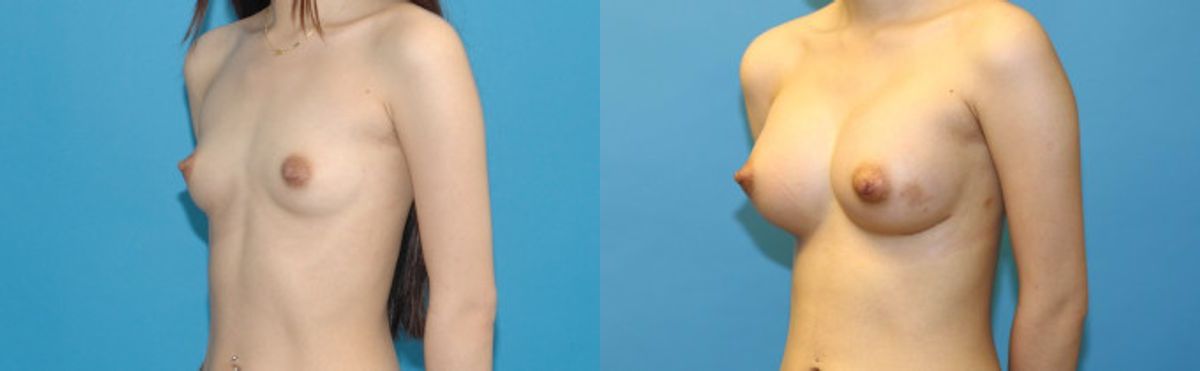 Breast Augmentation with Breast Implants #114 - Before and After