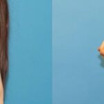 Breast Augmentation with Breast Implants #114 - Before and After