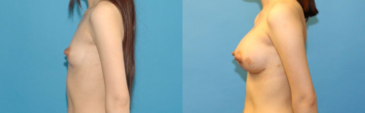 Breast Augmentation with Breast Implants #114 - Before and After