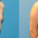 Breast Augmentation with Breast Implants #114 - Before and After
