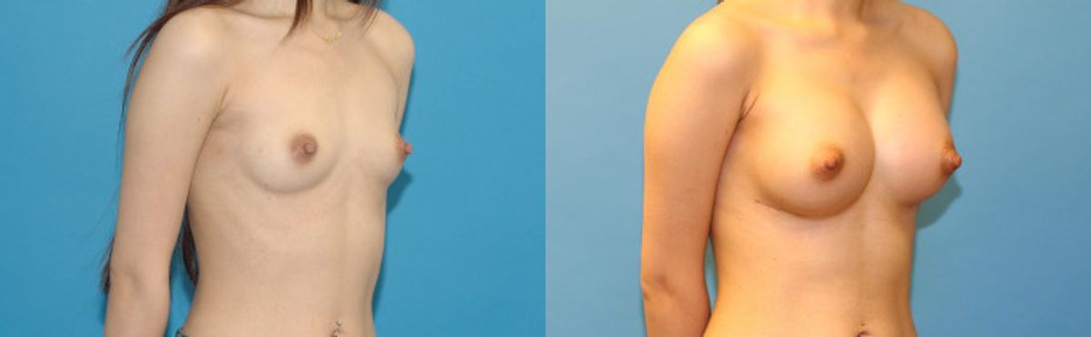 Breast Augmentation with Breast Implants #114 - Before and After