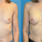 Breast Implant #108 - Before and After