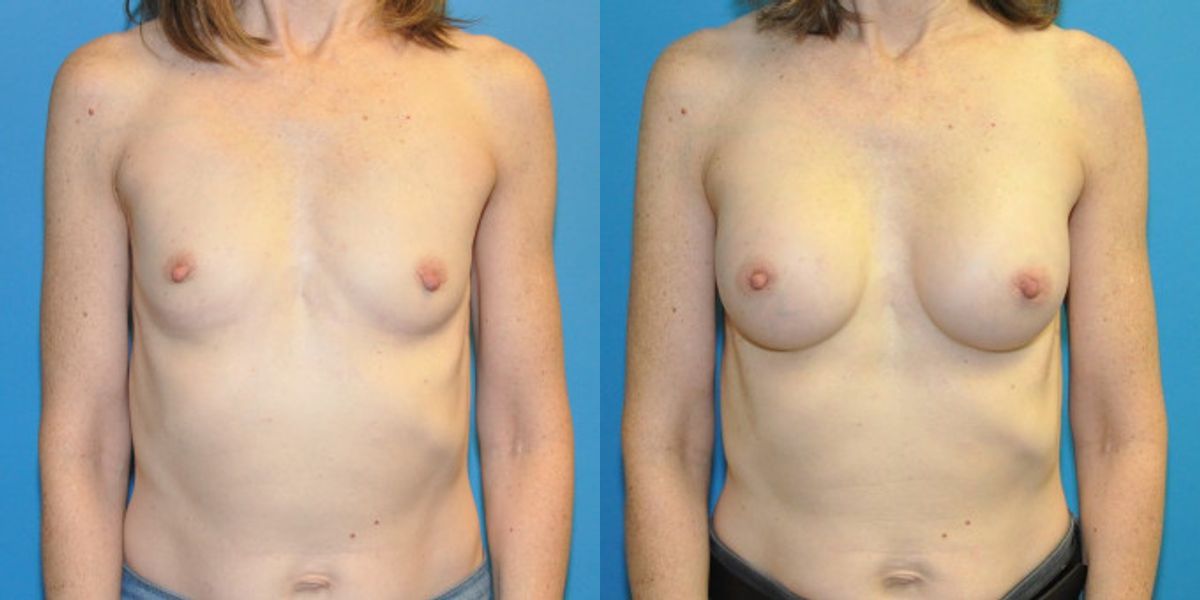 Breast Implant #108 - Before and After