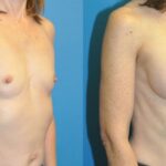 Breast Implant #108 - Before and After