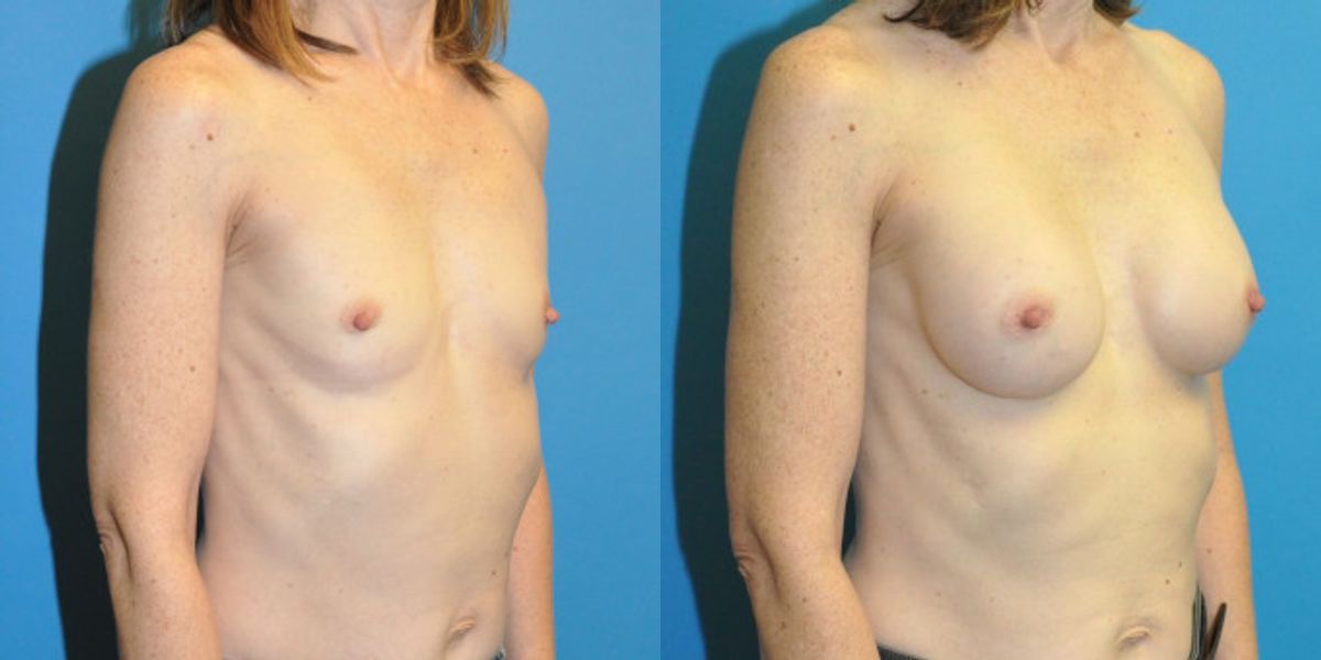 Breast Implant #108 - Before and After