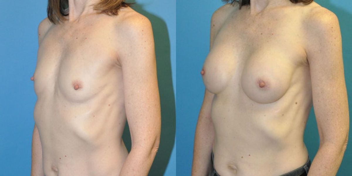 Breast Implant #108 - Before and After