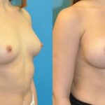 Breast Implant #116 - Before and After