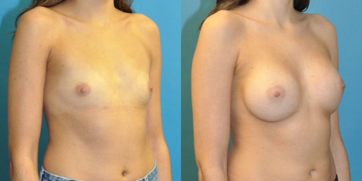 Breast Implant #117 - Before and After
