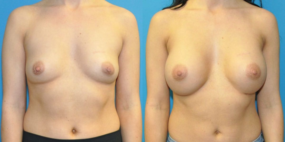 Breast Implant #118 - Before and After