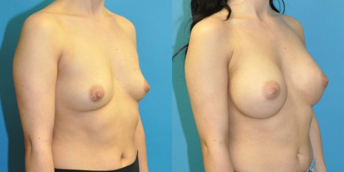 Breast Implant #118 - Before and After
