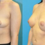 Breast Implant #118 - Before and After