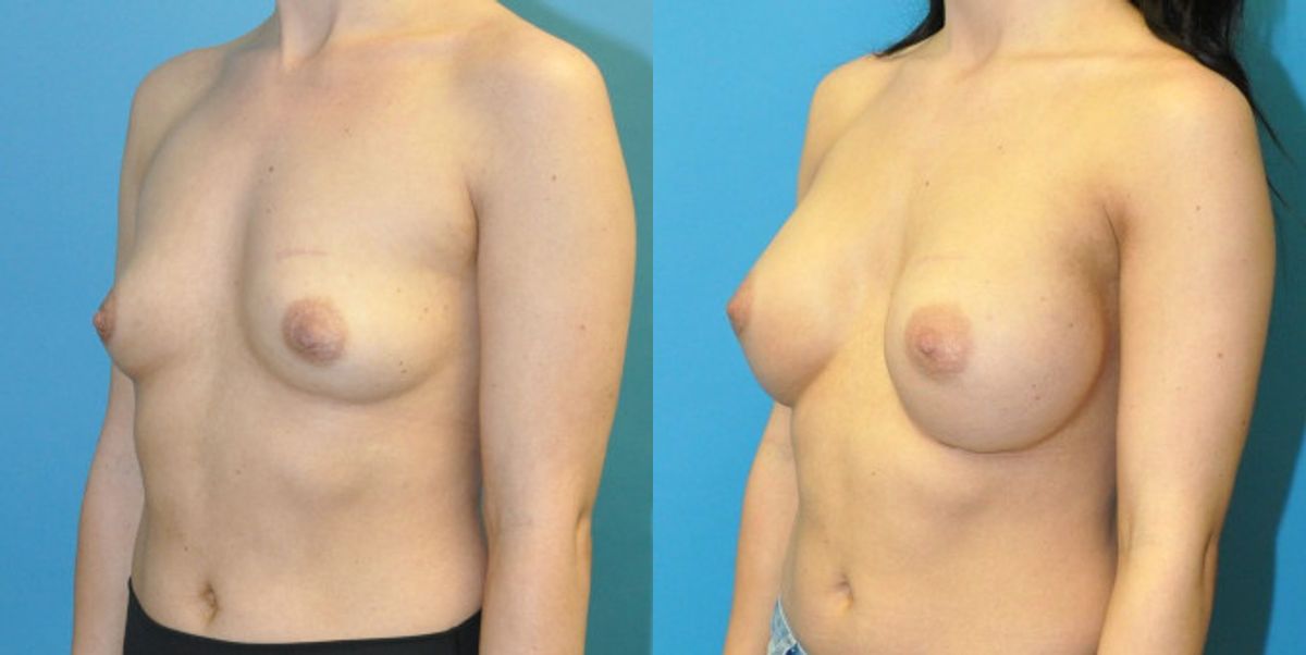 Breast Implant #118 - Before and After
