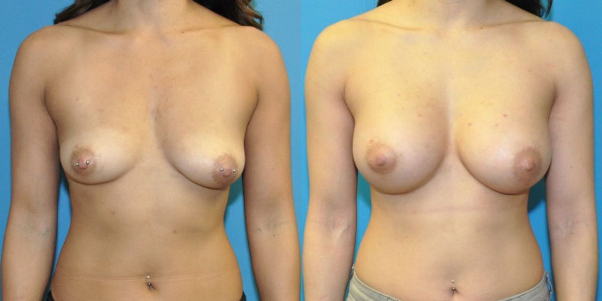Breast Implant #119 - Before and After