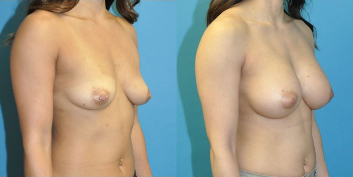 Breast Implant #119 - Before and After