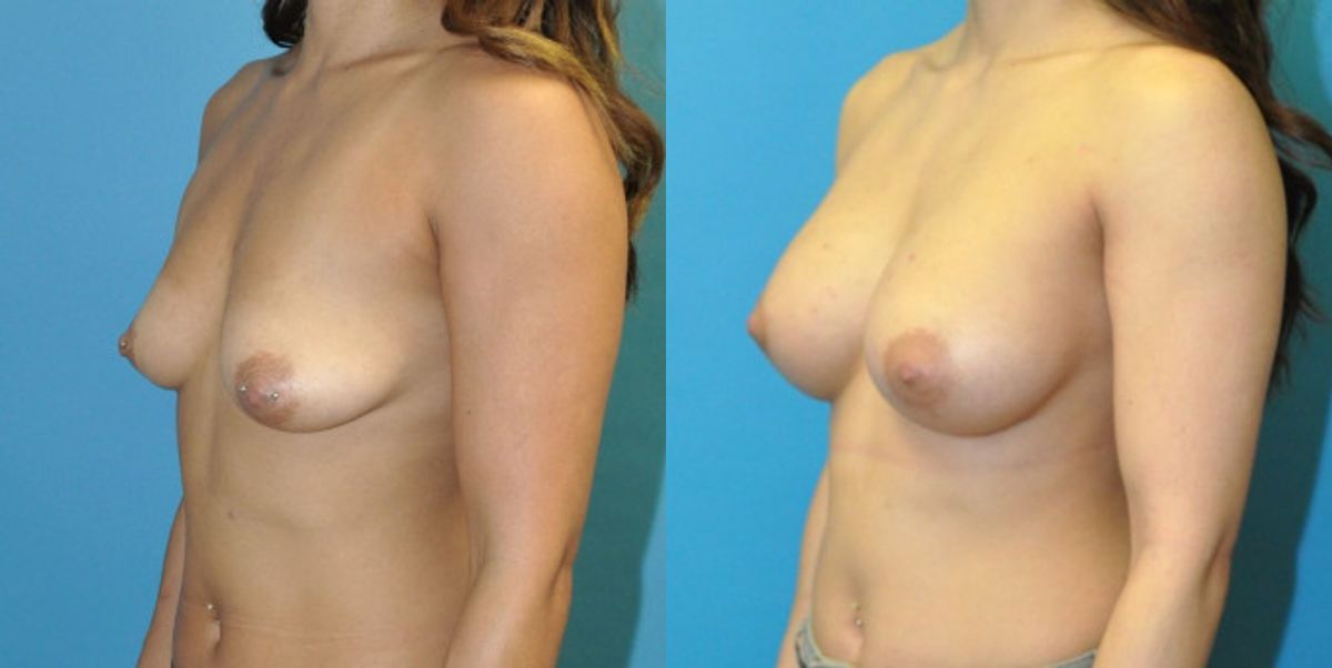 Breast Implant #119 - Before and After