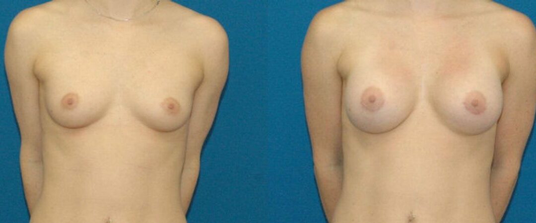Breast Implant #12