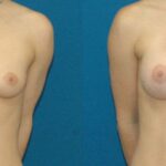 Breast Implant #12 - Before and After