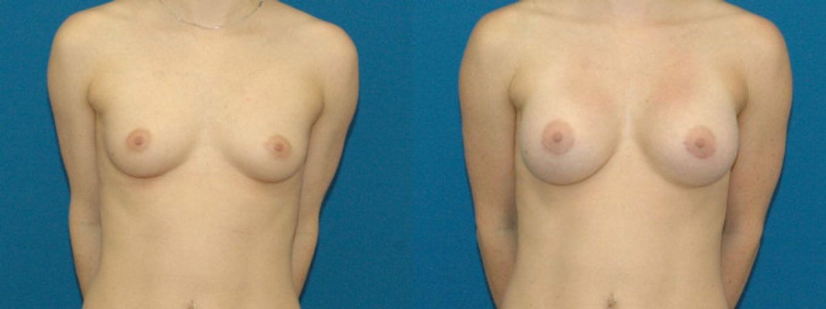 Breast Implant #12 - Before and After