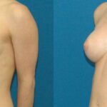 Breast Implant #12 - Before and After