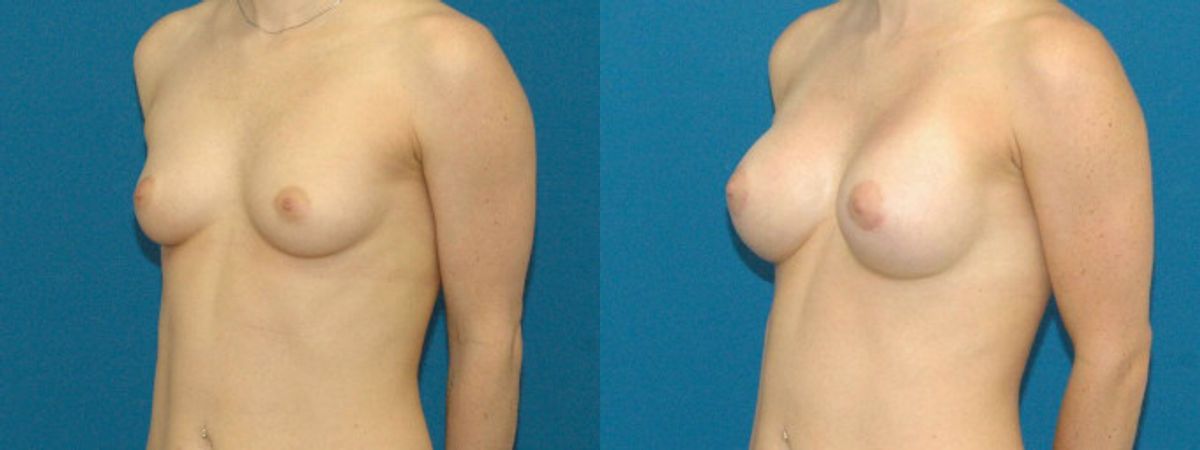 Breast Implant #12 - Before and After